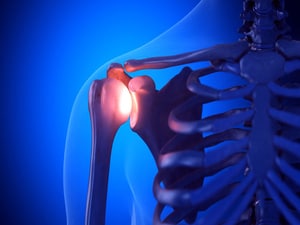 Early Surgery for Shoulder Instability May Prevent Osteoarthritis