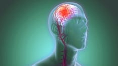 Little Benefit From Adding Aspiration to Thrombectomy for Stroke