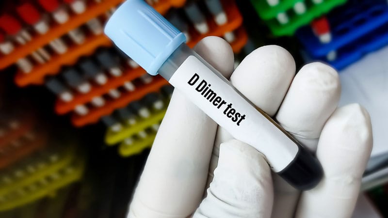 D-dimer Unreliable for Ruling Out PE in COVID-19 