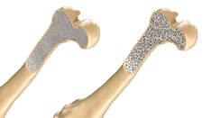Docs Gain New Flexibility Treating Osteoporosis From Steroids