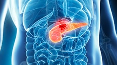 Pancreatic Cancer: Practice Essentials, Pathophysiology, Etiology