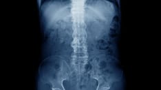 Bimekizumab Tames Active Ankylosing Spondylitis in BE MOBILE 2