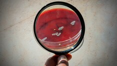 Researcher Revisits '03 Guidance on Monkeypox in Pregnant Women