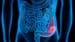 Colorectal Cancer Incidence Doubled in Younger Adults