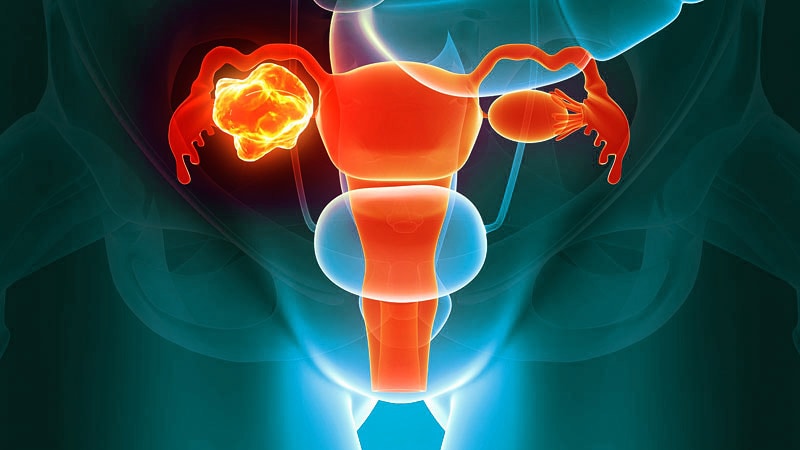 Ovarian Cancer | Medscape