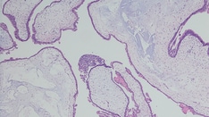 The Role of Repeat Uterine Curettage in Postmolar Gestational Trophoblastic Neoplasia