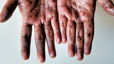 Monkeypox Presentations, Prevention Strategies Shifting