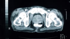 Many With Prostate Cancer Have Vertebral Fracture at ADT Onset