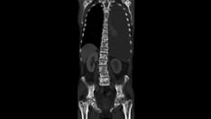 'Groundbreaking': Prophylactic Radiotherapy Ups Survival 