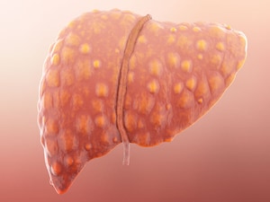 Steroids, G-CSF Up 90-day Survival in Severe Alcoholic Hepatitis