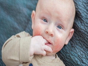 Infant Anaphylaxis: Study Characterizes Symptoms, Treatment