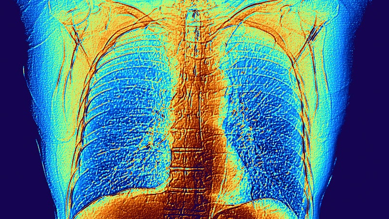 Pulmonary Arterial Hypertension | Medscape