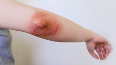 Off-Label Dupilumab Gains Off-Label Uses as Clinicians Turn to Drug for More Indications