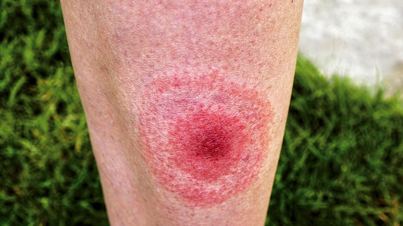 Lyme Disease | Medscape