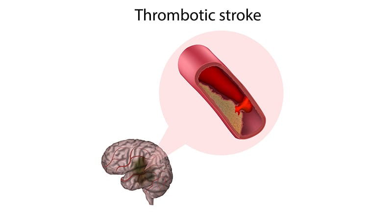 Thrombectomy Improves Outcomes in Pediatric Stroke