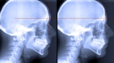 Feminizing Cranioplasty Yields Measurable Radiographic Changes for Male-to-Female Transgender Patients