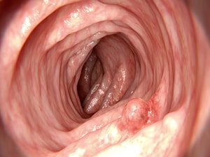 Cold vs Hot Snare of Large Polyps: Less AEs, More Recurrence