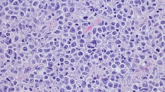 Misdiagnoses, Lack of Biomarkers Among Challenges in Managing Cutaneous Lymphoma