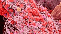 Q&A: Thromboembolism Management in Paroxysmal Nocturnal Hemoglobinuria