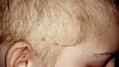 Hair Disorders: Finding the Root of the Problem