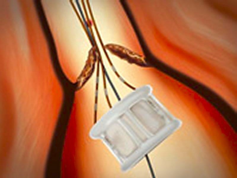 Special Report: Transcatheter Aortic Valves