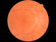 An Airbag Deploys, Leaving Vision Blurry and Distorted Despite Treatment