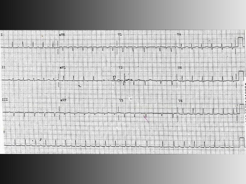 'Inappropriate' Sinus Tachycardia