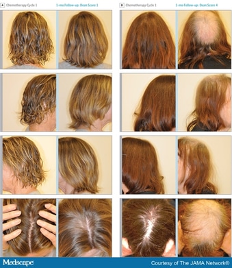 Scalp Cooling To Prevent Chemo Hair Loss Shows Promise