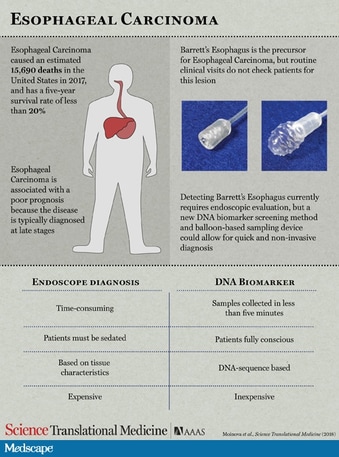 Swallowable Balloon Device Detects Barrett S Esophagus