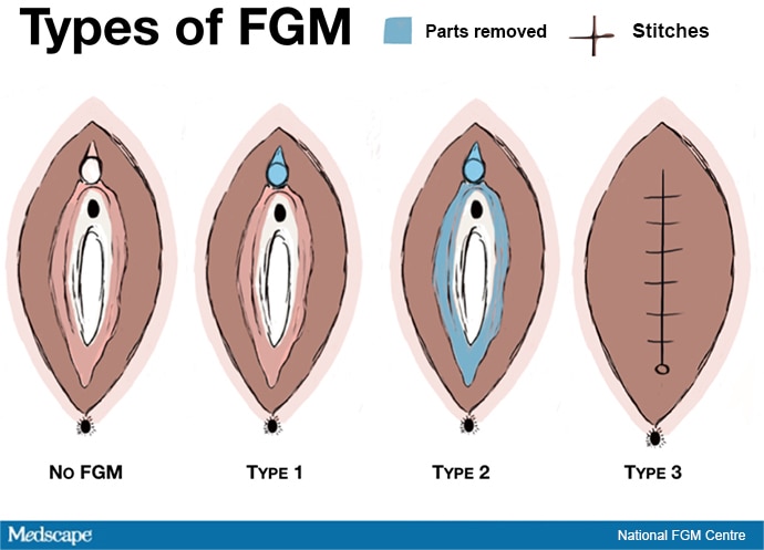 Girls Khatna Videos Sex - Under the Radar: Female Genital Mutilation in the United States