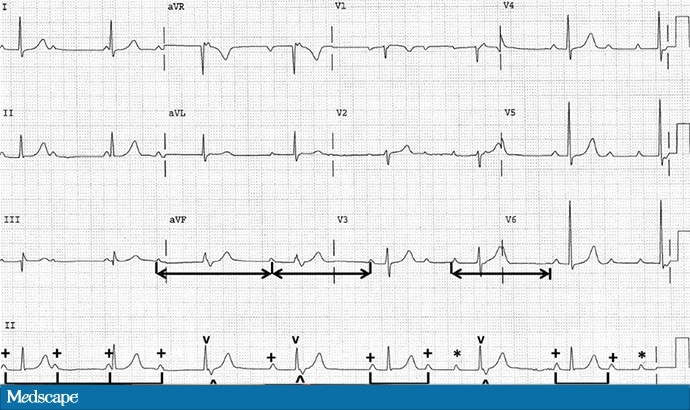 Ecg Challenge Why Is His Pulse So Slow