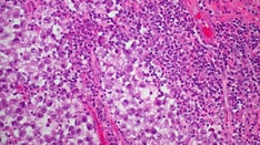 Testicular Disorders: Trouble Doesn't Always Come in Pairs