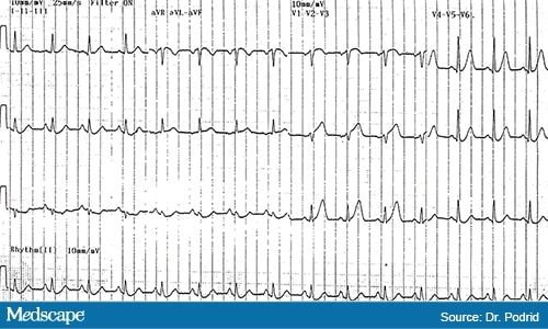 Ecg Challenge Recurring Chest Pain In The Hospital