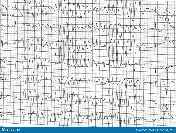 ECG Challenge: Teen With His First Seizure