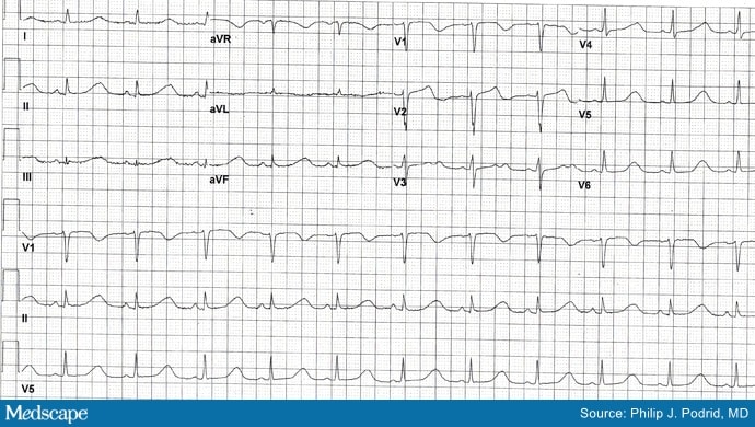 Ecg Challenge: Post-op Cramping And Spasms In Cancer Patient