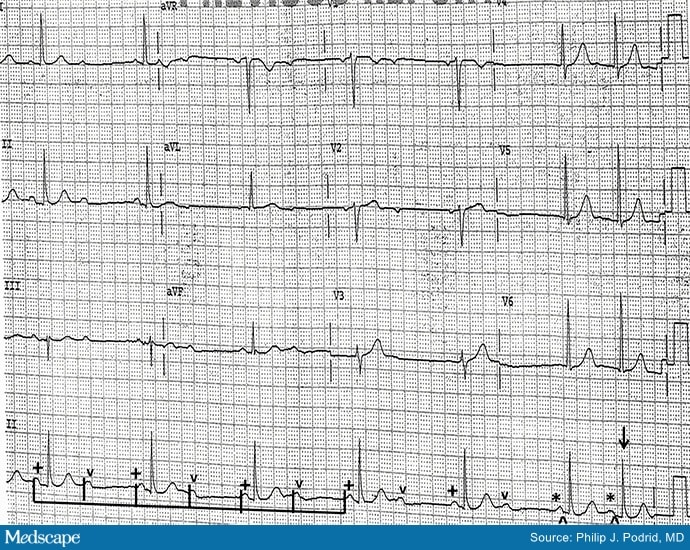 ECG Challenge: Feeling Tired and Lightheaded - Page 2