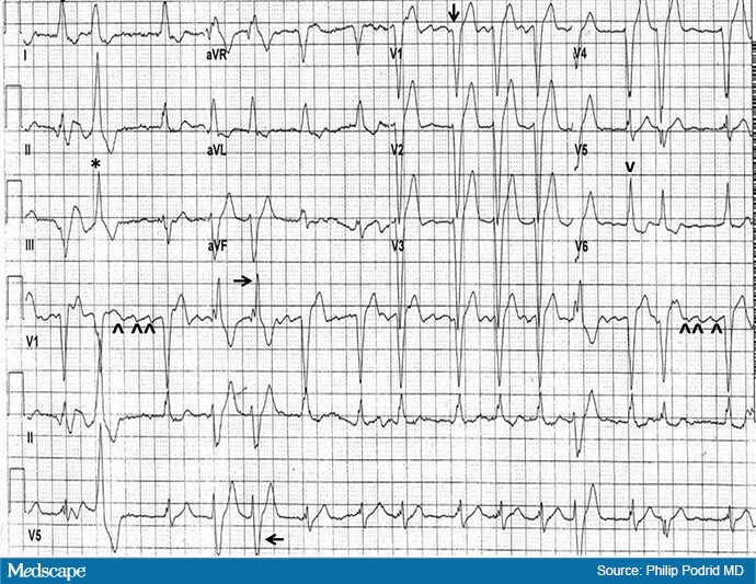 ECG Challenge: Heart Racing and Short of Breath - Page 2