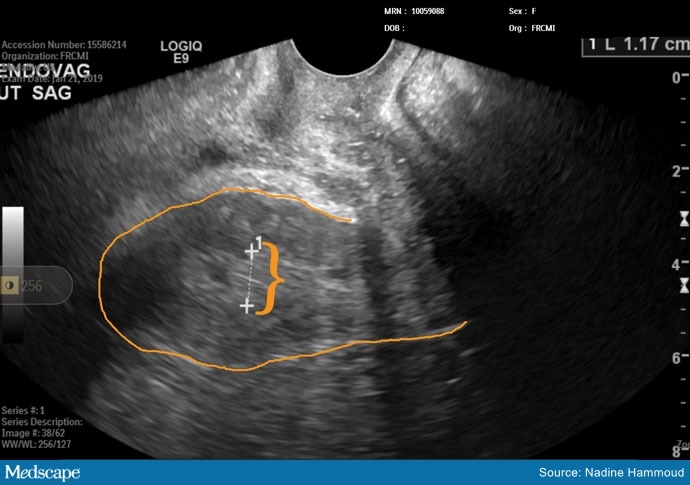 uterine-fibroids-causes-symptoms-and-treatment-meddo