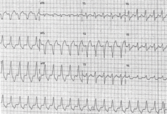 Atrioventricular Dissociation Background Pathophysiology Etiology