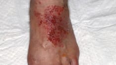 A Vegan Hiker With a Rash Self-Treated With Coconut Oil