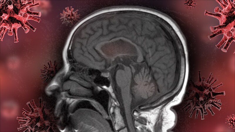 COVID-19 Linked to Increased Risk for Parkinson's
