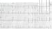 ECG Challenge: Did COPD Cause This Man's Irregular Heart Rate?