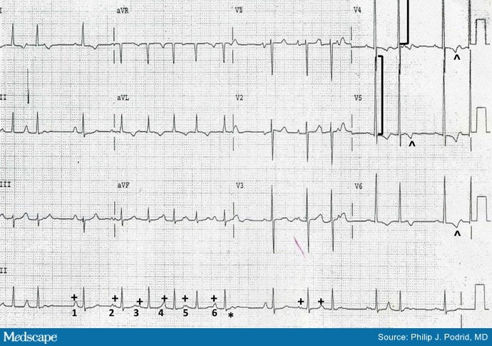 ECG Challenge: Did COPD Cause This Man's Irregular Heart Rate? - Page 2