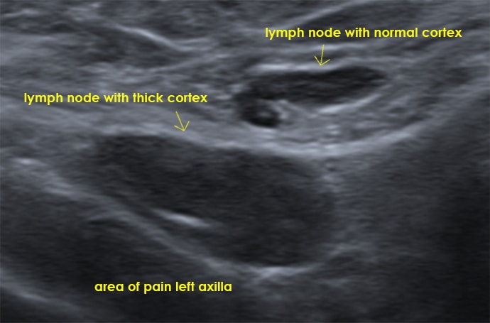 swollen supraclavicular lymph node after flu shot