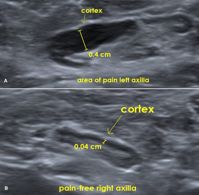 Painful Armpit Swelling After Covid Vaccine Next Steps