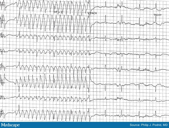 ECG Challenge: Abnormal Telemetry Before Cholecystectomy