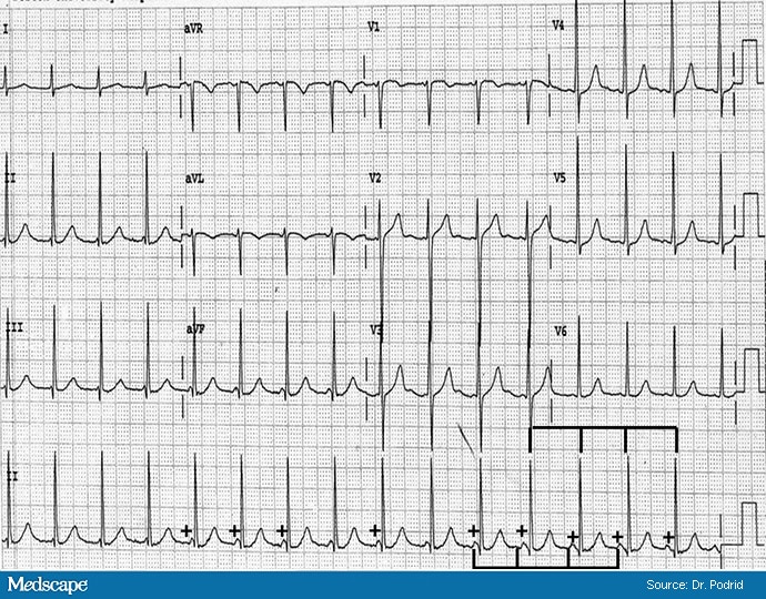 Ecg Challenge: Fast Heart Rate In Patient With Ra - Page 2