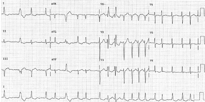 ECG Challenge: What Caused This Man's Atrial Arrhythmia?