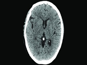Stroke Thrombectomy Alone Fails Noninferiority to Bridging tPA