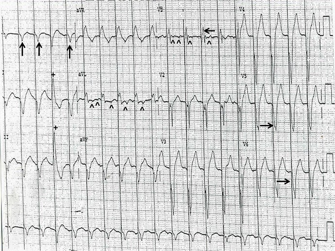 ECG Challenge: Fast Heartbeat With a Pacemaker - Page 2